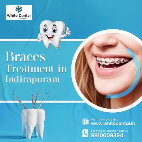 Braces Treatment in Indirapuram: Affordable & Effective